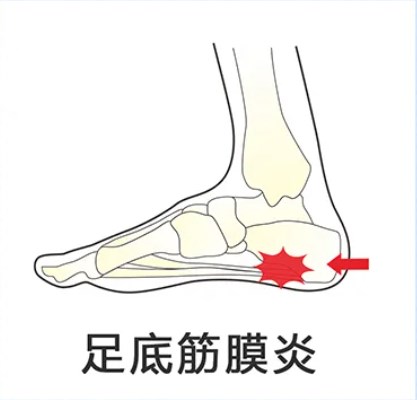 长时间用足需小心足底筋膜炎，穿着矫正鞋垫助缓解_新闻热点
